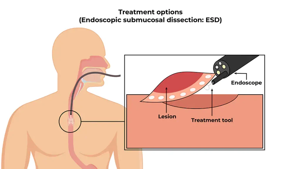 ESD-TRATEMENT